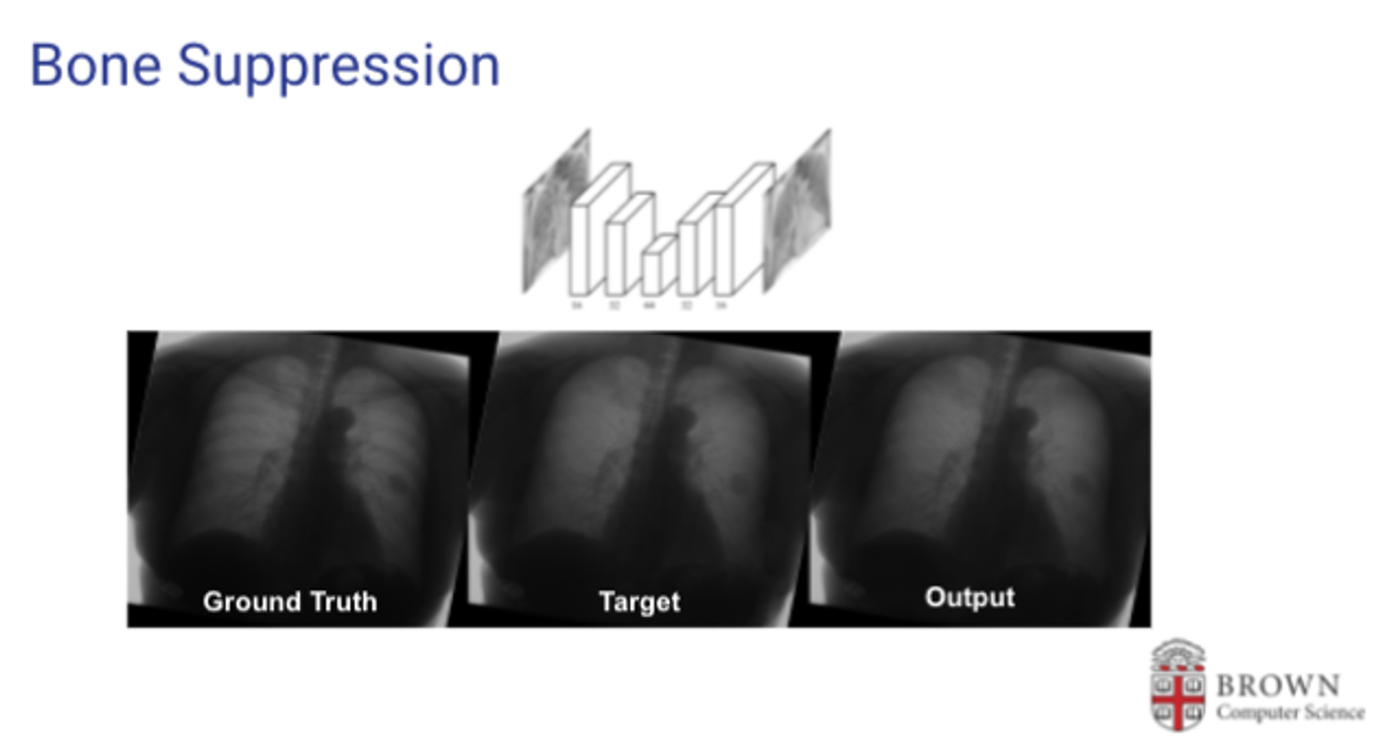 X-Ray Bone Suppression and Classification